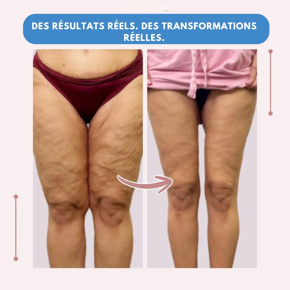 Leggings MoveLift 3D – Dites adieu naturellement à la douleur et au gonflement du lipœdème.