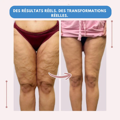 Leggings MoveLift 3D – Dites adieu naturellement à la douleur et au gonflement du lipœdème.