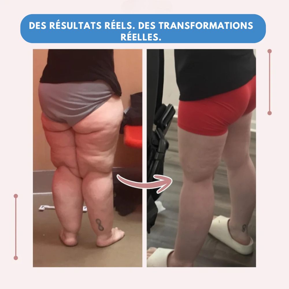 Leggings MoveLift 3D – Dites adieu naturellement à la douleur et au gonflement du lipœdème.