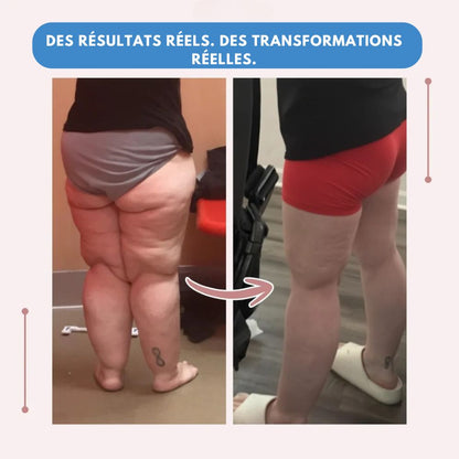 Leggings MoveLift 3D – Dites adieu naturellement à la douleur et au gonflement du lipœdème.