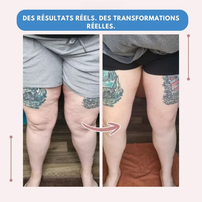 Leggings MoveLift 3D – Dites adieu naturellement à la douleur et au gonflement du lipœdème.