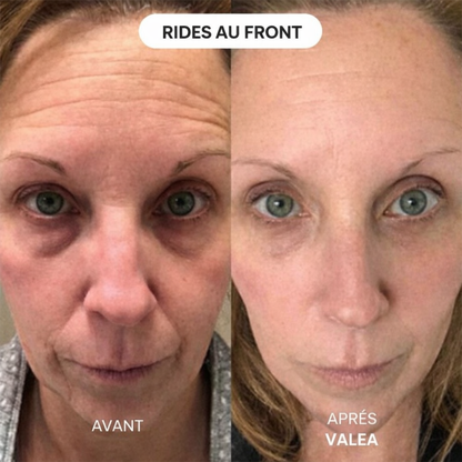 Micro-Infusion Lift Pro - VALEA