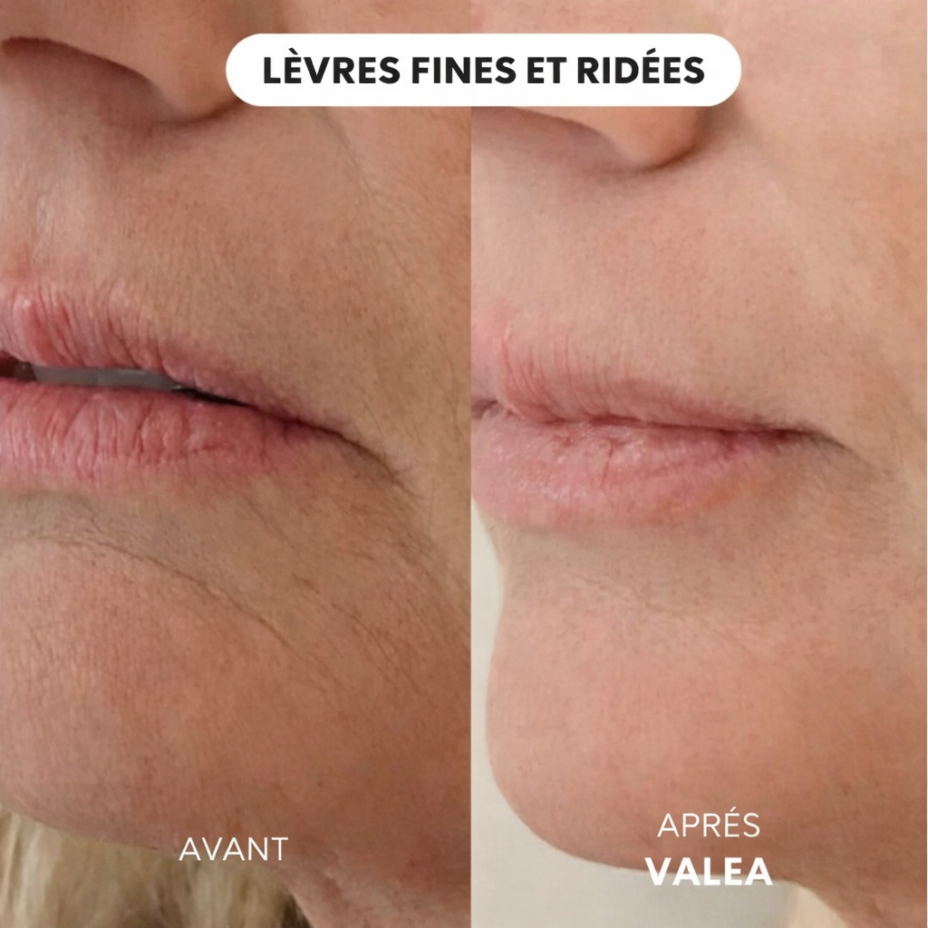 Micro-Infusion Lift Pro - VALEA