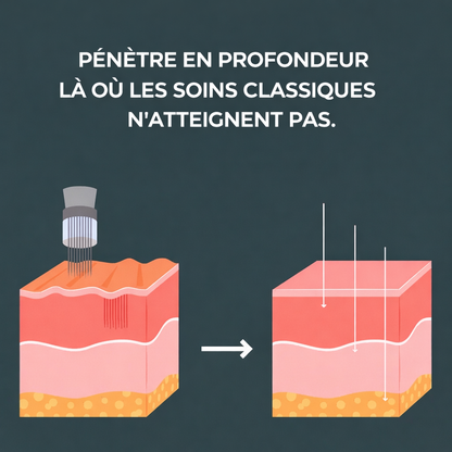 Micro-Infusion Lift Pro - VALEA