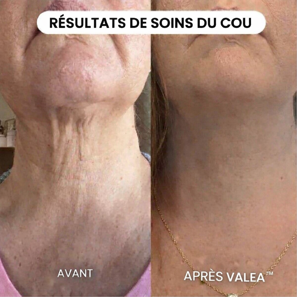 Micro-Infusion Lift Pro - VALEA