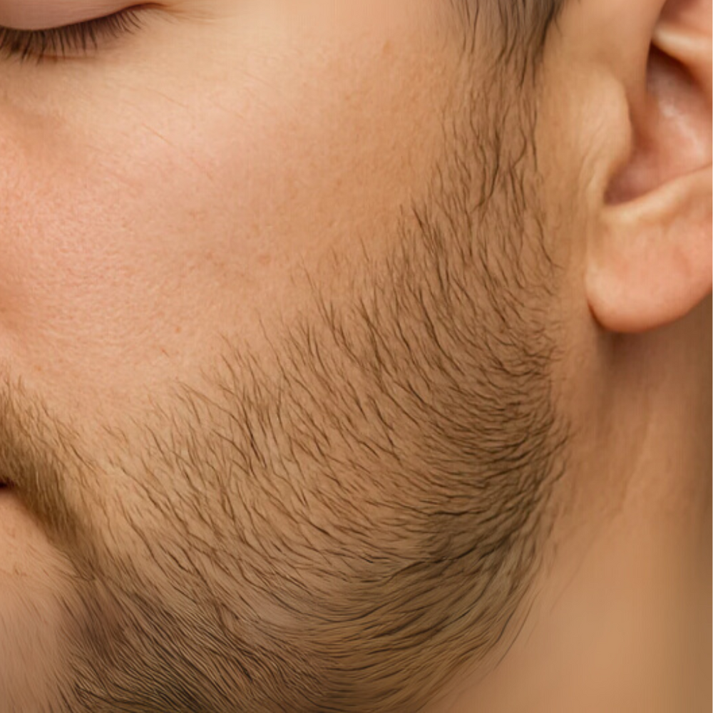 Apres traitement barbe