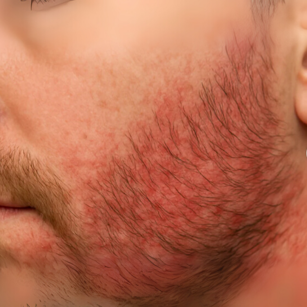 Avant traitement barbe