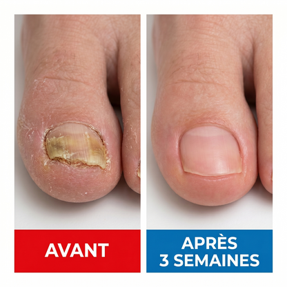 Fongix - Avant apres 3 semaines