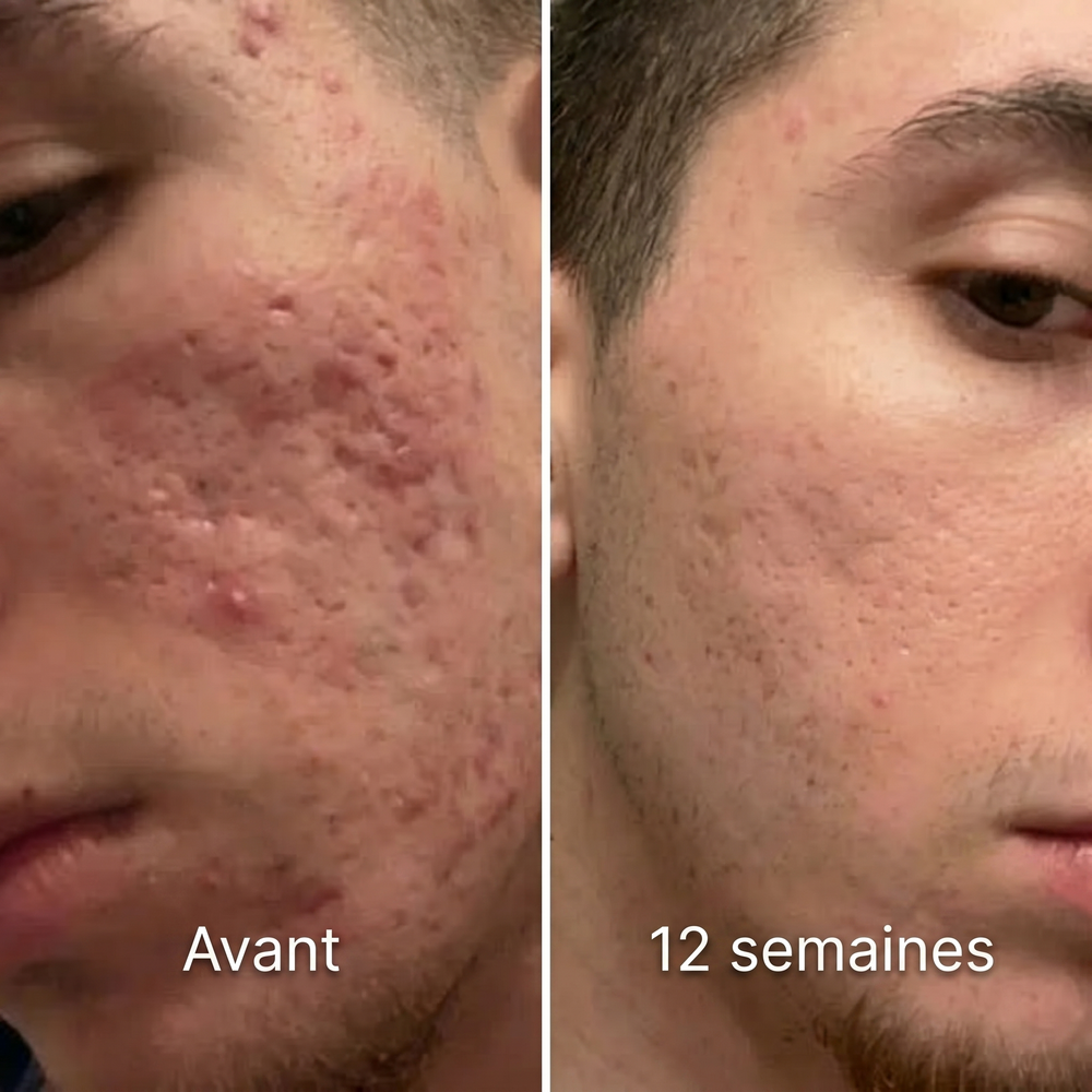 velura-before-after-12w-fr.png