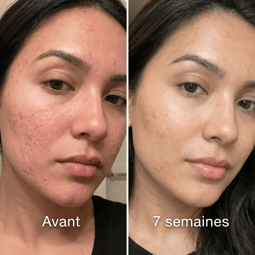 velura-before-after-7w-fr.png